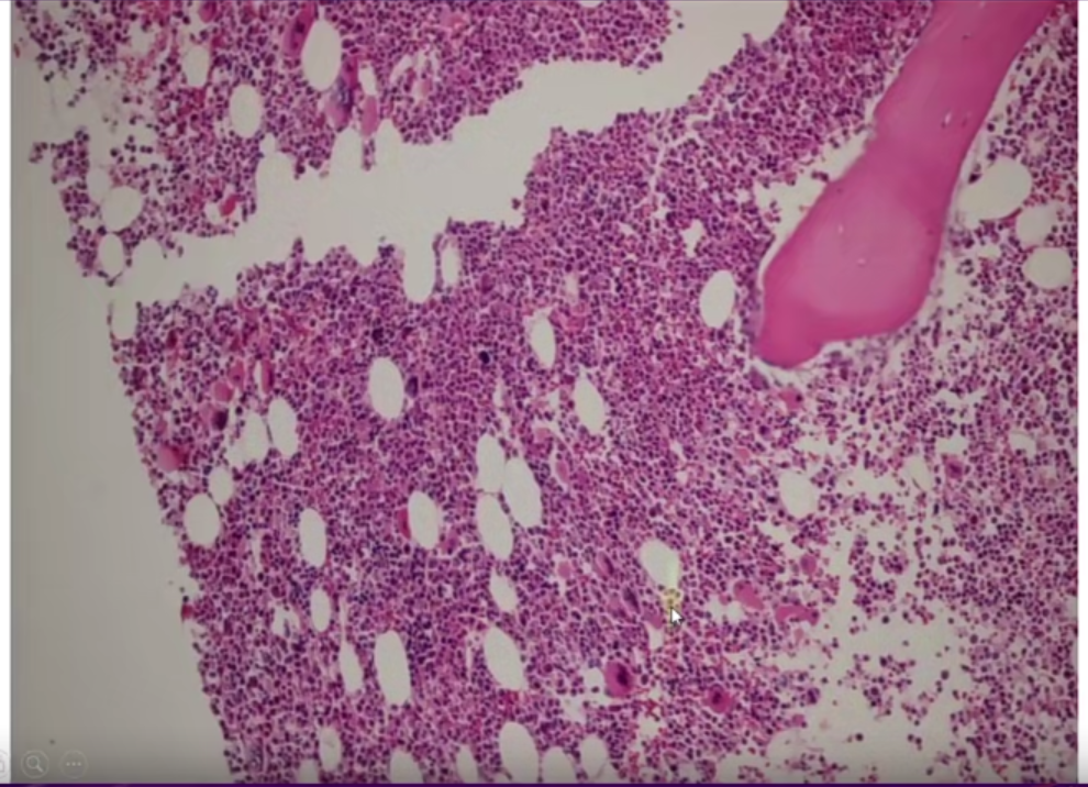 微信图片_20221017174442.png 张培红教授:骨髓增殖性肿瘤(MPN)的病理进展