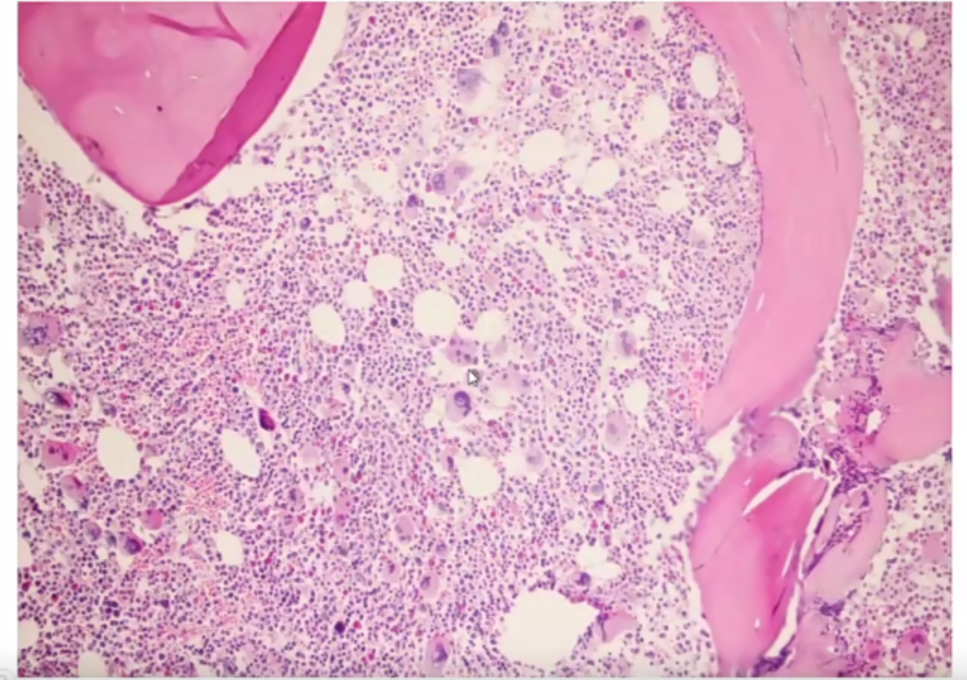 微信图片_20221017174308.png 张培红教授:骨髓增殖性肿瘤(MPN)的病理进展