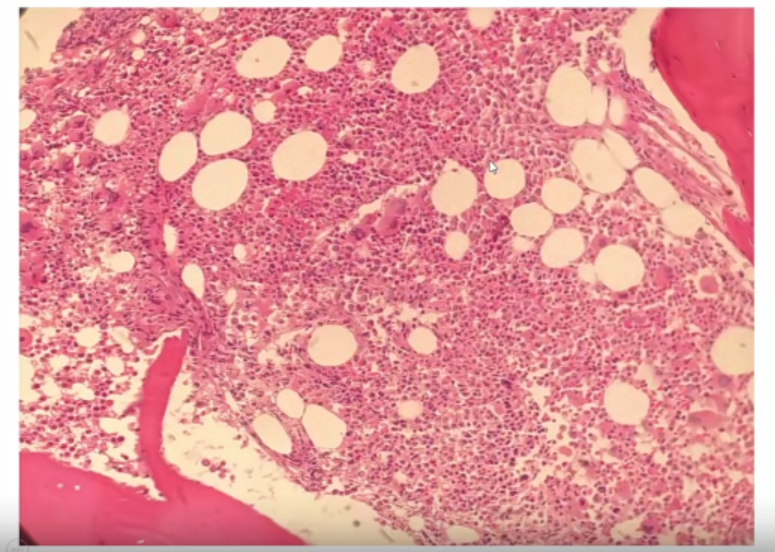 微信图片_20221017174835.png 张培红教授:骨髓增殖性肿瘤(MPN)的病理进展