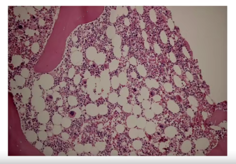 微信图片_20221017174635.png 张培红教授:骨髓增殖性肿瘤(MPN)的病理进展