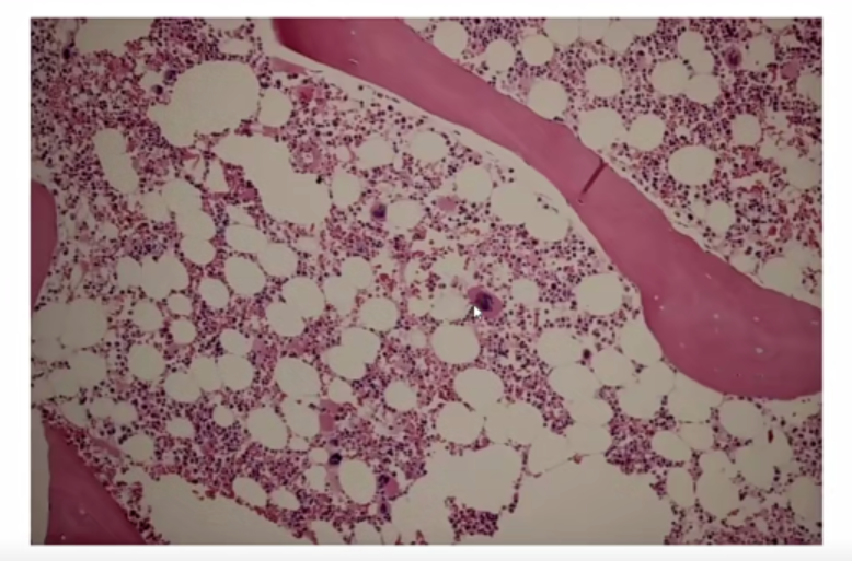 微信图片_20221017174641.png 张培红教授:骨髓增殖性肿瘤(MPN)的病理进展