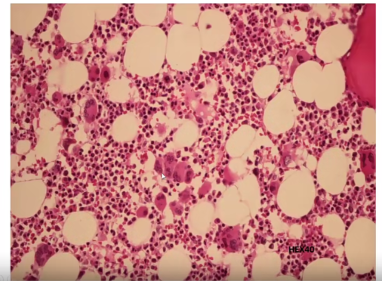 微信图片_20221017174831.png 张培红教授:骨髓增殖性肿瘤(MPN)的病理进展