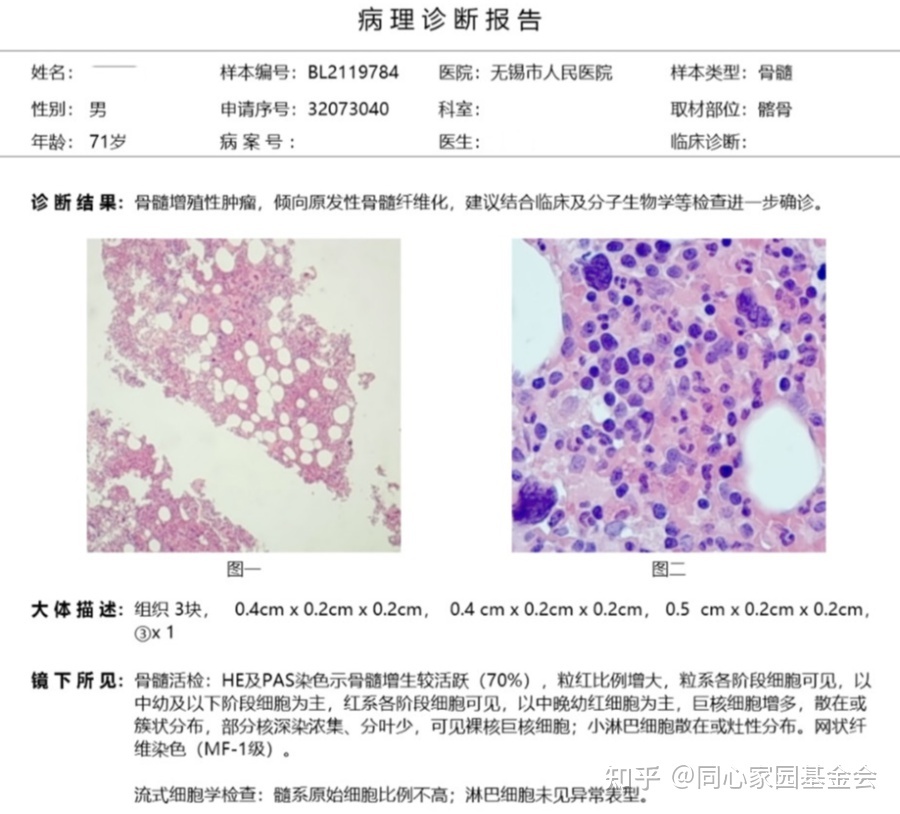 一例早期原发性骨髓纤维化的诊断历程