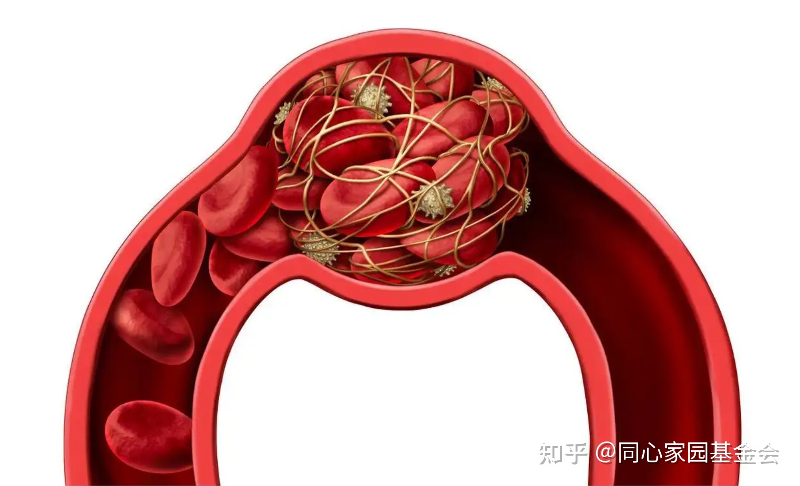 骨髓增殖性肿瘤血栓并发症的治疗展望