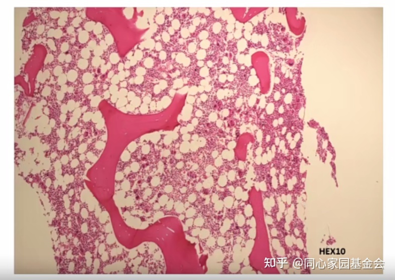 专家讲座|张培红教授:骨髓增殖性肿瘤(MPN)的病理展望