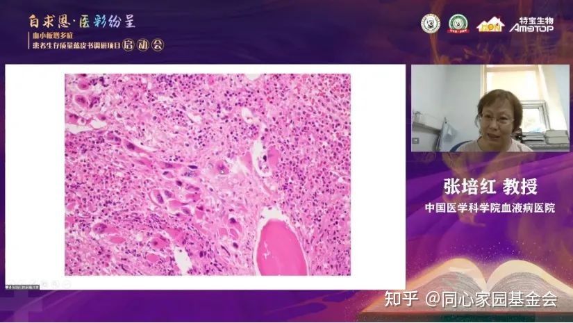 专家讲座|张培红教授:骨髓增殖性肿瘤(MPN)的病理展望