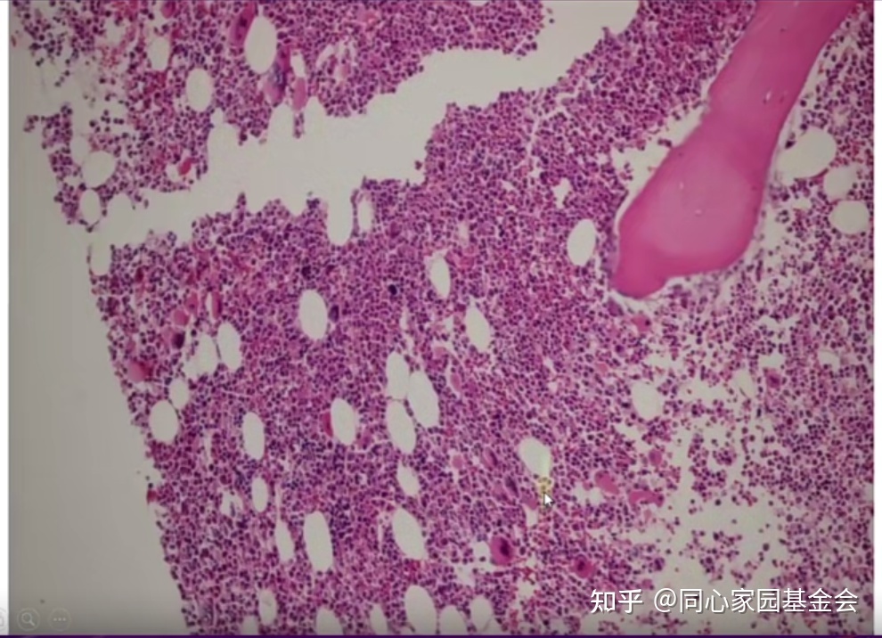 专家讲座|张培红教授:骨髓增殖性肿瘤(MPN)的病理展望