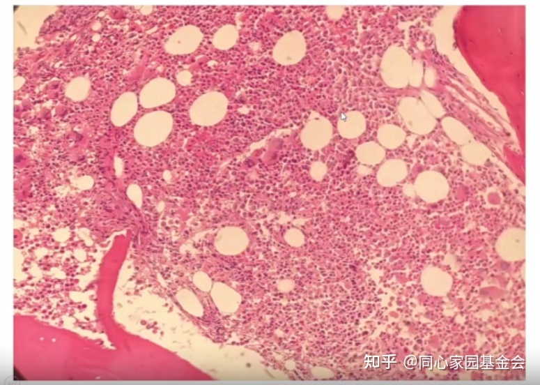 专家讲座|张培红教授:骨髓增殖性肿瘤(MPN)的病理展望