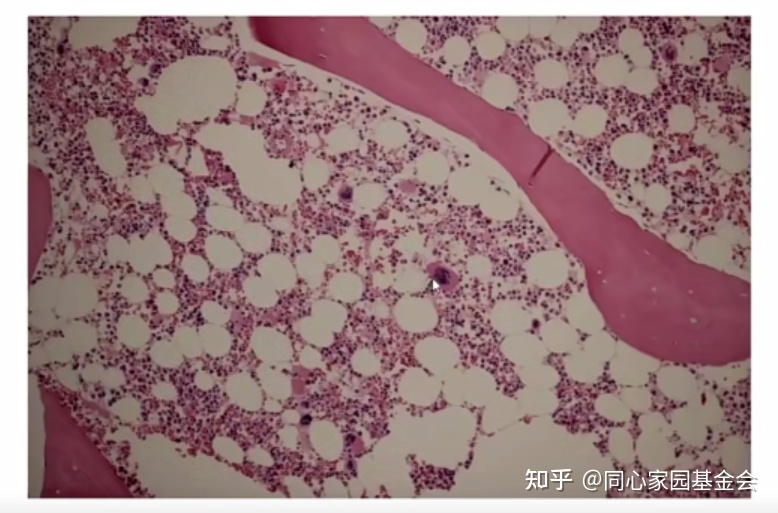 专家讲座|张培红教授:骨髓增殖性肿瘤(MPN)的病理展望