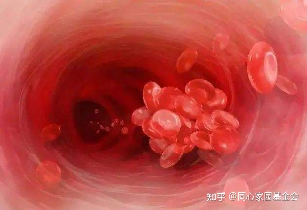 骨髓增生异常综合征(MDS)离白血病“不远”了吗?