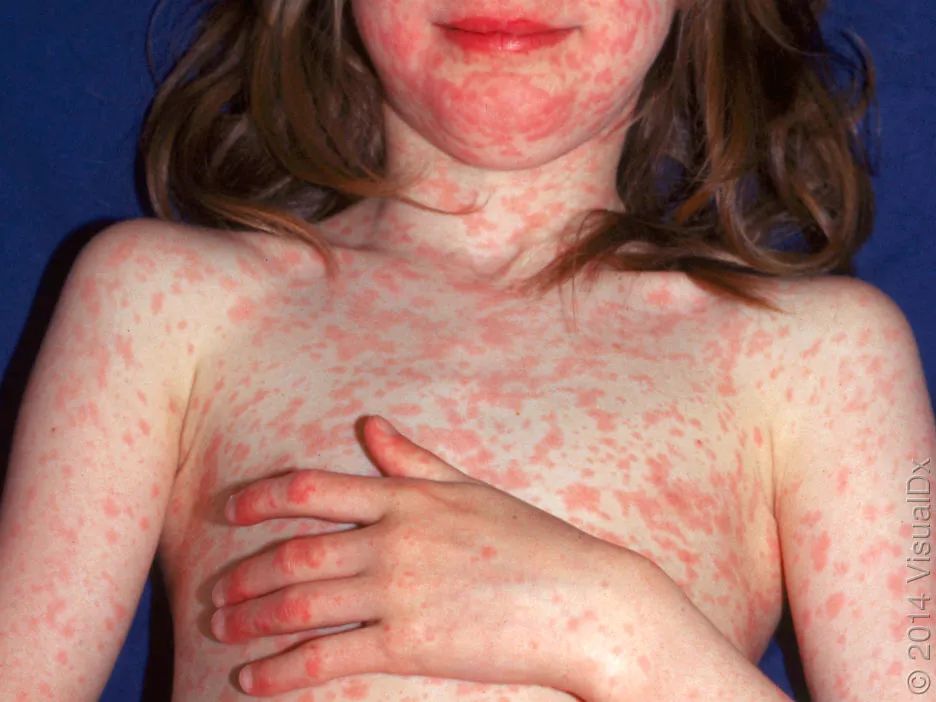 孩子生病后中性粒细胞减少是什么原因?什么时候用升粒细胞的药物? 孩子生病后中性粒细胞减少是什么原因?什么时候用升粒细胞的药物?