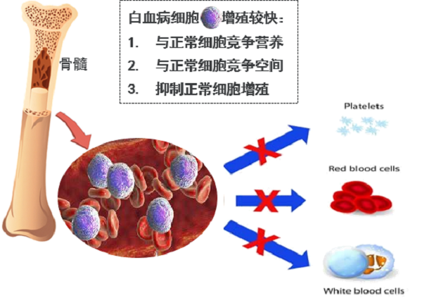 急性淋巴细胞白血病化疗需要多久?预后如何? 急性淋巴细胞白血病化疗需要多久?预后如何?