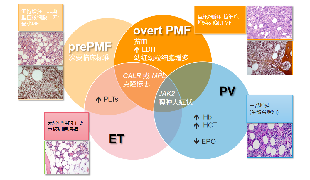专家讲座 | 真性红细胞增多症（PV）的概述及最新进展（上）