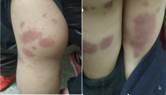 遇到过敏性紫癜就用激素？具备这些指征才可以