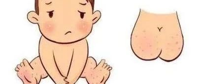 “狡猾”的皮疹——过敏性紫癜