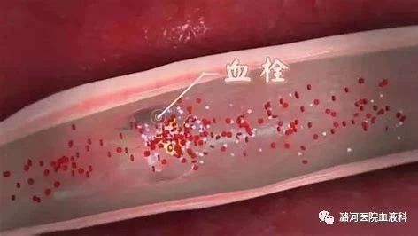易栓症筛查三项知多少