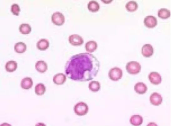 一文了解,什么是骨髓增生异常综合征(MDS) 一文了解,什么是骨髓增生异常综合征(MDS)