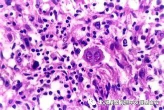 霍奇金淋巴瘤是良还是恶？