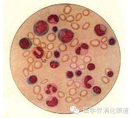 黄疸——当心是巨幼细胞性贫血惹的祸 黄疸——当心是巨幼细胞性贫血惹的祸