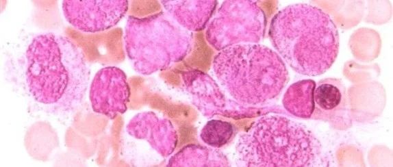 认识急性早幼粒细胞白血病