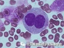 霍奇金淋巴瘤是良还是恶？