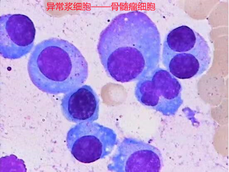 容易被误诊的血液肿瘤:多发性骨髓瘤 容易被误诊的血液肿瘤:多发性骨髓瘤