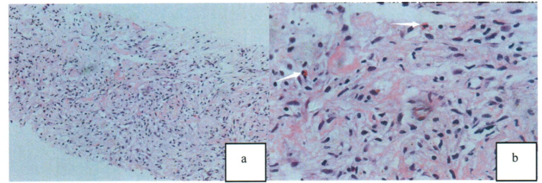 嗜酸性粒细胞增多的 10 大原因,最后一种很容易误诊! 嗜酸性粒细胞增多的 10 大原因,最后一种很容易误诊!