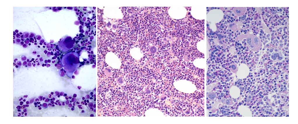 专家讲座 | 真性红细胞增多症（PV）的概述及最新进展（上）