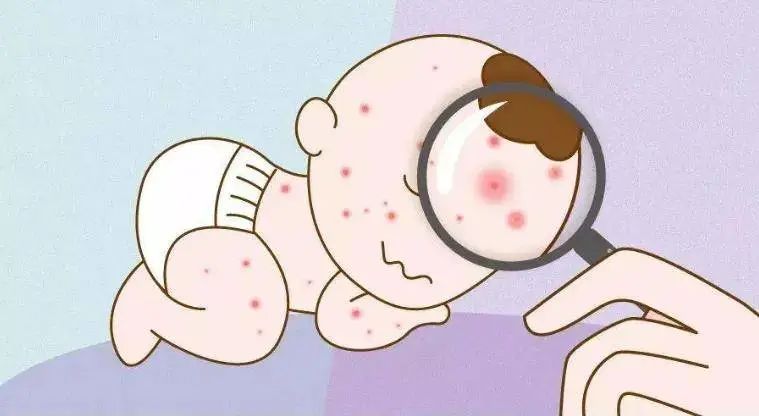 过敏性紫癜,其实跟过敏关系不大,而且“大朋友“也会中招! 过敏性紫癜,其实跟过敏关系不大,而且“大朋友“也会中招!