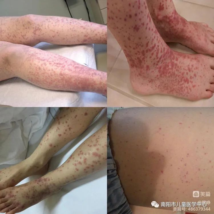 “狡猾”的皮疹——过敏性紫癜 “狡猾”的皮疹——过敏性紫癜