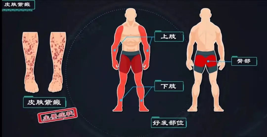 【健康科普】过敏性紫癜怎么办？