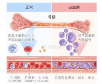 急性早幼粒细胞白血病可以用砒霜治愈,“以毒攻毒”!是真的吗? 急性早幼粒细胞白血病可以用砒霜治愈,“以毒攻毒”!是真的吗?