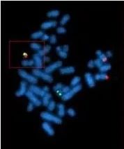 科普宣教 | 什么是急性淋巴细胞白血病? 科普宣教 | 什么是急性淋巴细胞白血病?