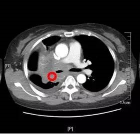 一起了解霍奇金淋巴瘤