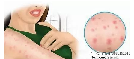 过敏性紫癜如何诊断和治疗? 过敏性紫癜如何诊断和治疗?