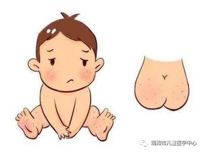 “狡猾”的皮疹——过敏性紫癜 “狡猾”的皮疹——过敏性紫癜