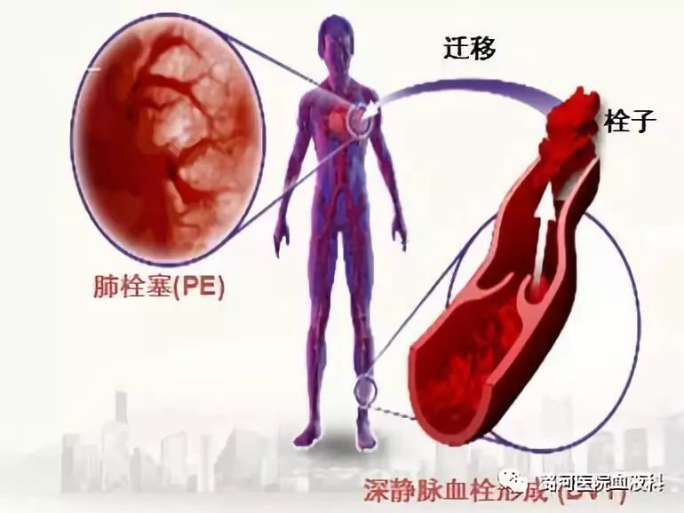 易栓症筛查三项知多少 易栓症筛查三项知多少