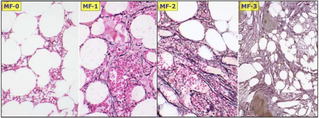 专家讲座 | 徐泽锋教授：原发性骨纤维化（PMF）的规范诊疗