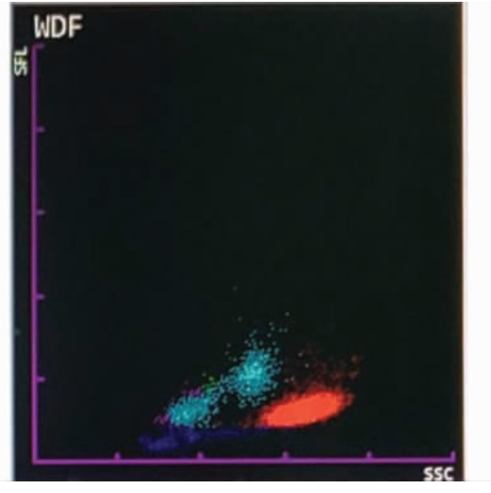 嗜酸性粒细胞增多的 10 大原因,最后一种很容易误诊! 嗜酸性粒细胞增多的 10 大原因,最后一种很容易误诊!