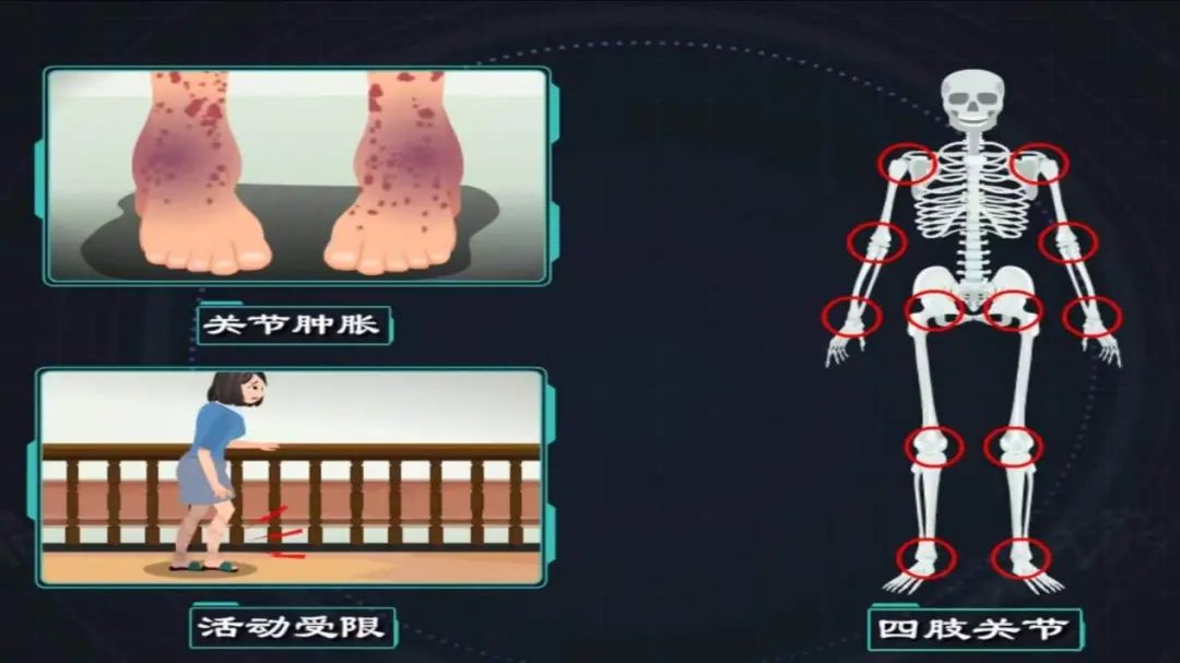 【健康科普】过敏性紫癜怎么办？