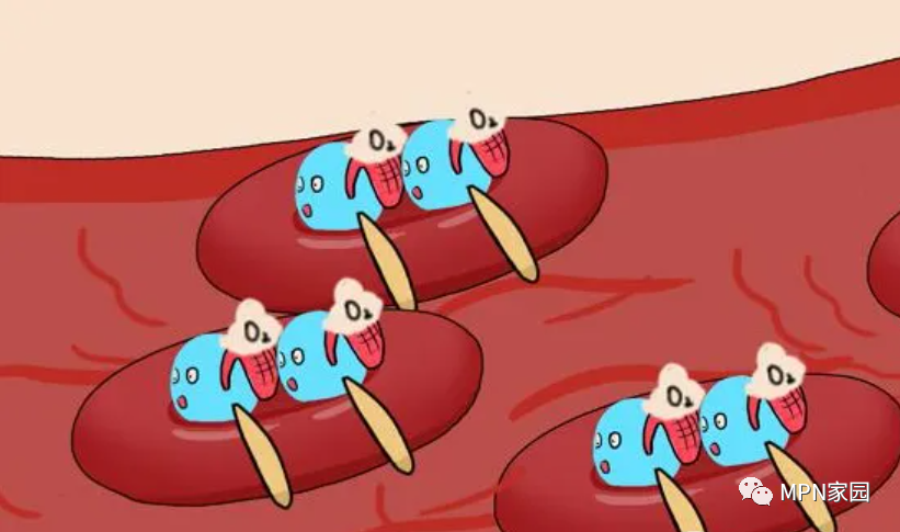 大咖零距离 | 张敏教授:真性红细胞增多症(PV)患者如何进行日常的“疾病管理”? 大咖零距离 | 张敏教授:真性红细胞增多症(PV)患者如何进行日常的“疾病管理”?