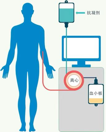 Q&amp;A | 你见过血小板单采吗？