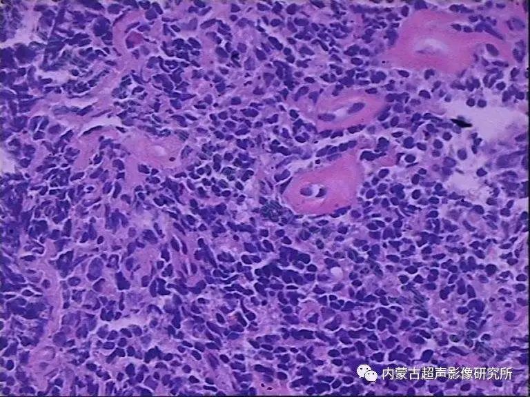 非霍奇金淋巴瘤的化疗方案有哪些？