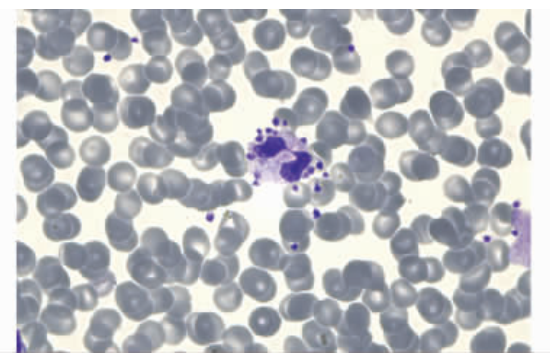 嗜酸性粒细胞增多的 10 大原因,最后一种很容易误诊! 嗜酸性粒细胞增多的 10 大原因,最后一种很容易误诊!