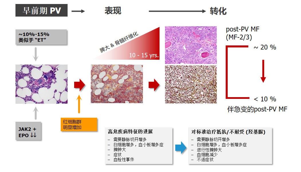 专家讲座 | 真性红细胞增多症（PV）的概述及最新进展（上）