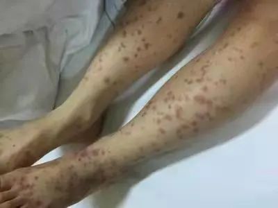 【健康科普】过敏性紫癜怎么办？