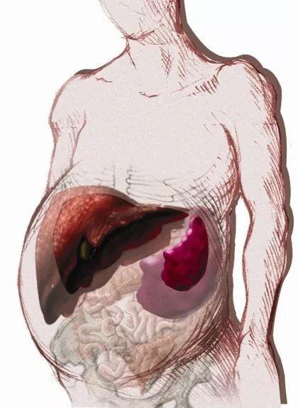 科普时间 | MPN患者,你的肝大了吗? 科普时间 | MPN患者,你的肝大了吗?