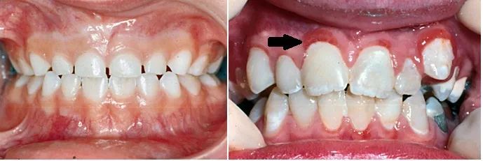 孩子生病后中性粒细胞减少是什么原因?什么时候用升粒细胞的药物? 孩子生病后中性粒细胞减少是什么原因?什么时候用升粒细胞的药物?
