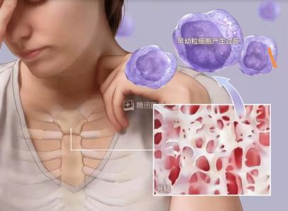 急性早幼粒细胞白血病可以用砒霜治愈,“以毒攻毒”!是真的吗? 急性早幼粒细胞白血病可以用砒霜治愈,“以毒攻毒”!是真的吗?