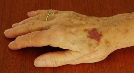 科普宣教 | 什么是急性淋巴细胞白血病? 科普宣教 | 什么是急性淋巴细胞白血病?